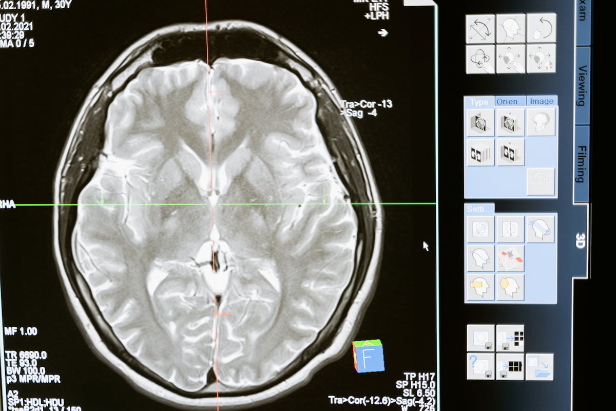 new research children with epilepsy