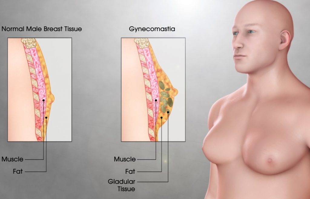 What Is The Pinch Test for Gynecomastia?